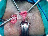 fistula in anob