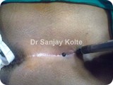 pilonidal sinus 1g