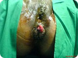 prolapsed pilesi